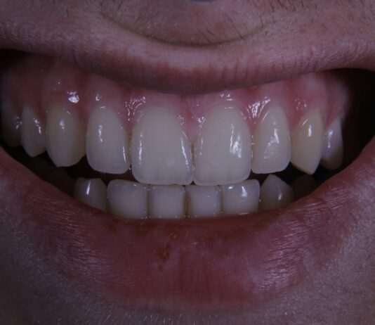 “자고 일어났더니 턱이 뻐근해요”… 스트레스가 부른 ‘이갈이(브럭시즘)’의 진실 a close up of a person's mouth with a missing tooth